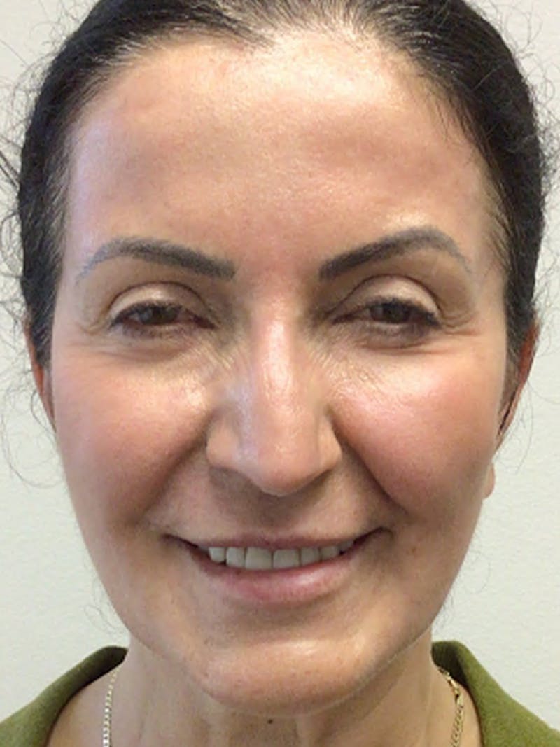 Fat Transfer Before & After Gallery - Patient 536682 - Image 2