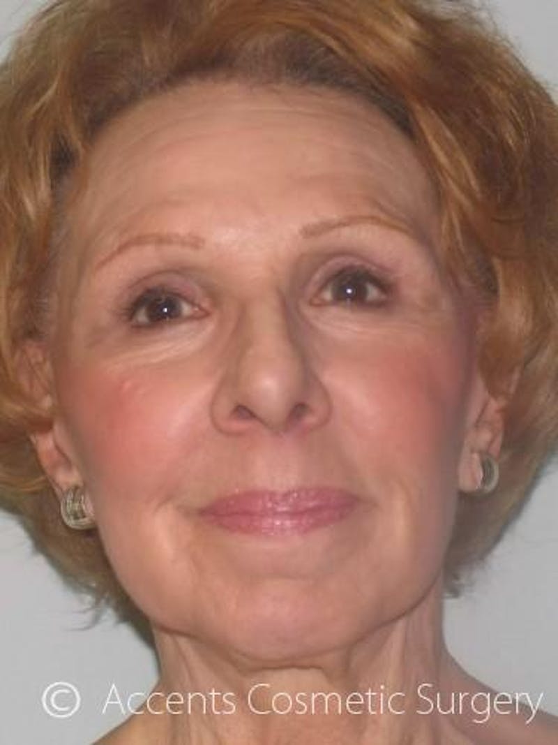 Fat Transfer Before & After Gallery - Patient 220347 - Image 2