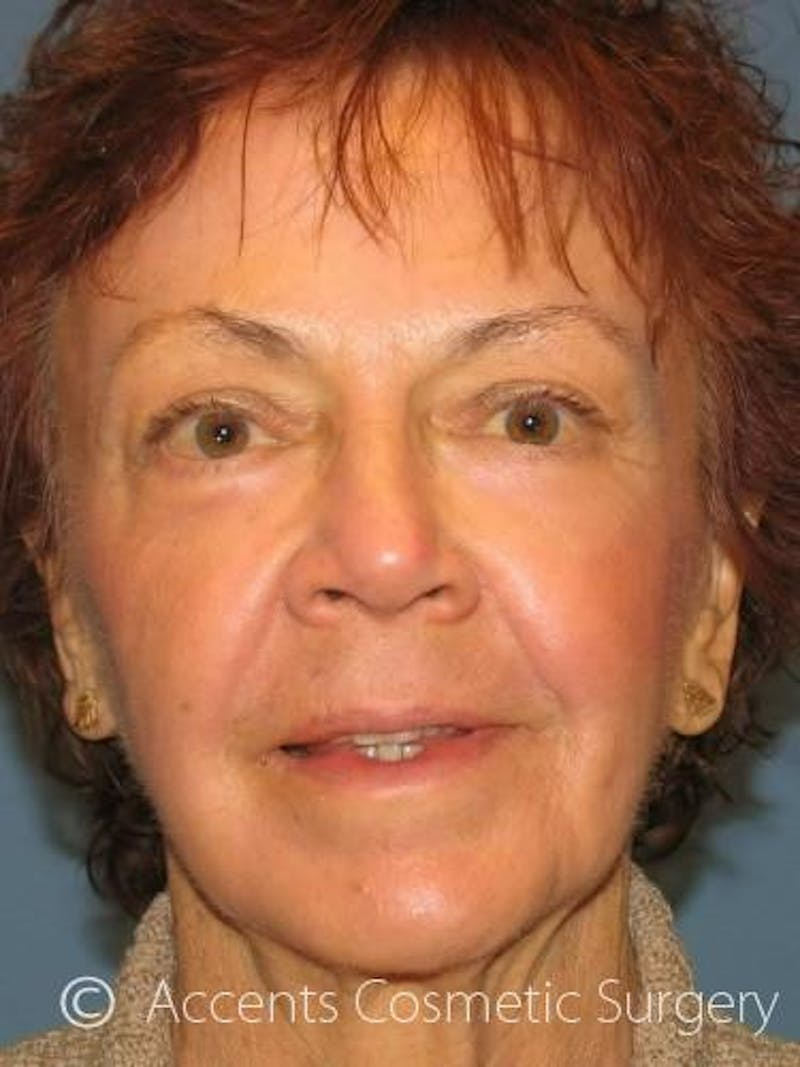 Fat Transfer Before & After Gallery - Patient 255697 - Image 2