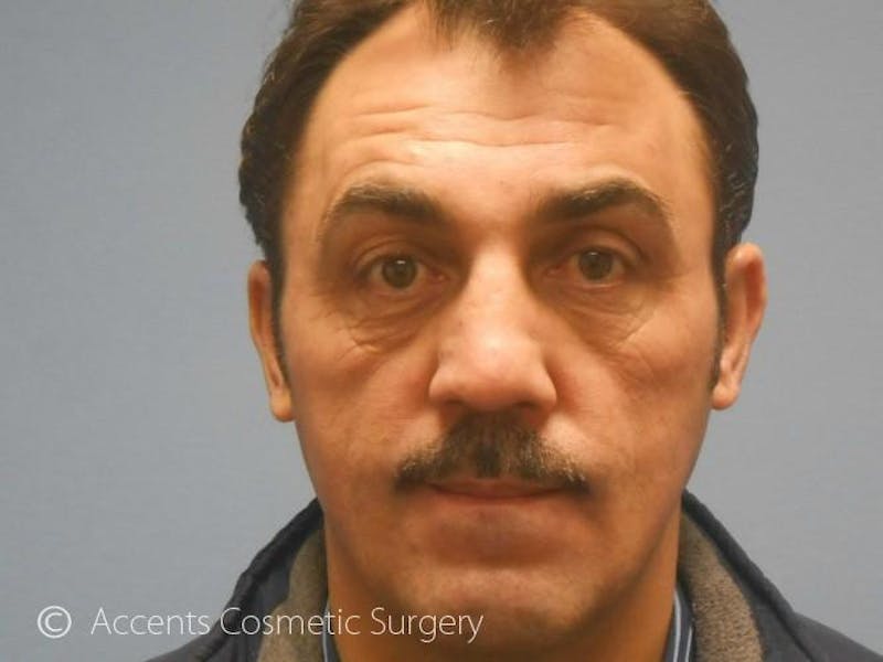 Fat Transfer Before & After Gallery - Patient 260832 - Image 1