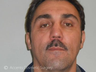 Fat Transfer Before & After Gallery - Patient 260832 - Image 2