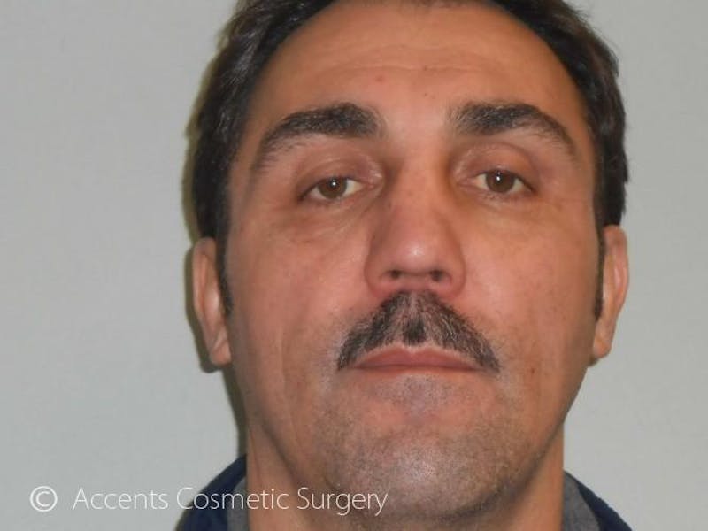 Fat Transfer Before & After Gallery - Patient 260832 - Image 2