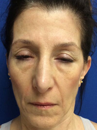 Fat Transfer Before & After Gallery - Patient 951465 - Image 1