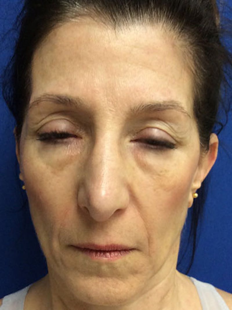 Fat Transfer Before & After Gallery - Patient 951465 - Image 1