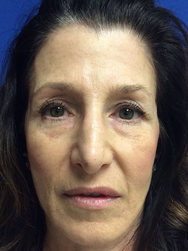 Fat Transfer Before & After Gallery - Patient 951465 - Image 2