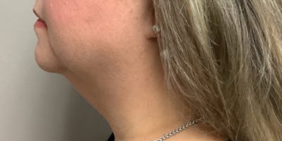 Neck Lipo Before & After Gallery - Patient 264029 - Image 1