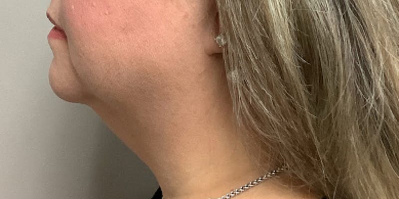 Neck Lipo Before & After Gallery - Patient 264029 - Image 1