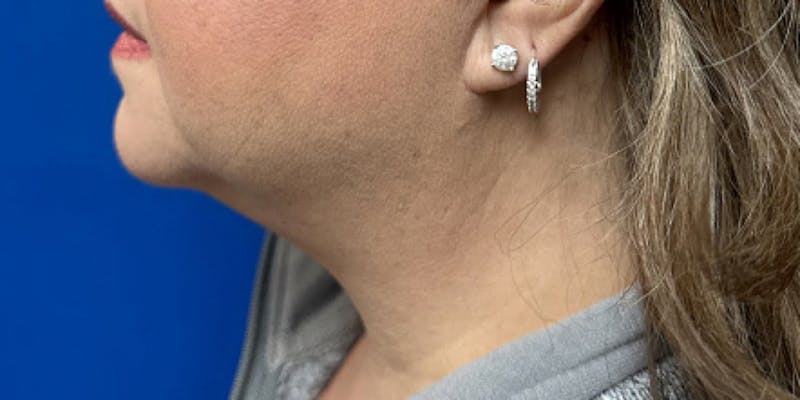Neck Lipo Before & After Gallery - Patient 264029 - Image 2