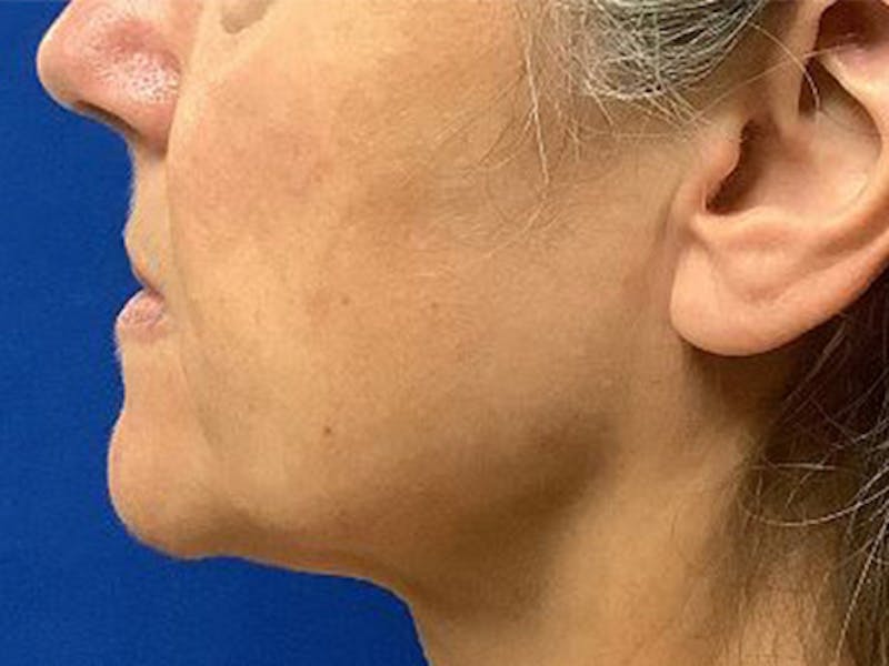 Neck Lipo Before & After Gallery - Patient 875100 - Image 1
