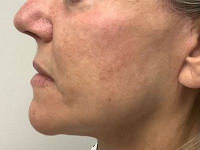 Neck Lipo Before & After Gallery - Patient 875100 - Image 2