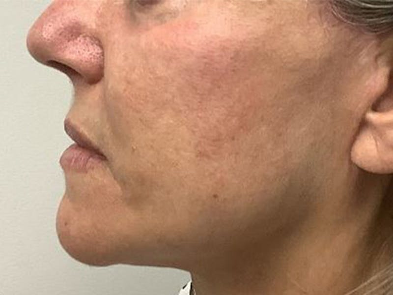 Neck Lipo Before & After Gallery - Patient 875100 - Image 2