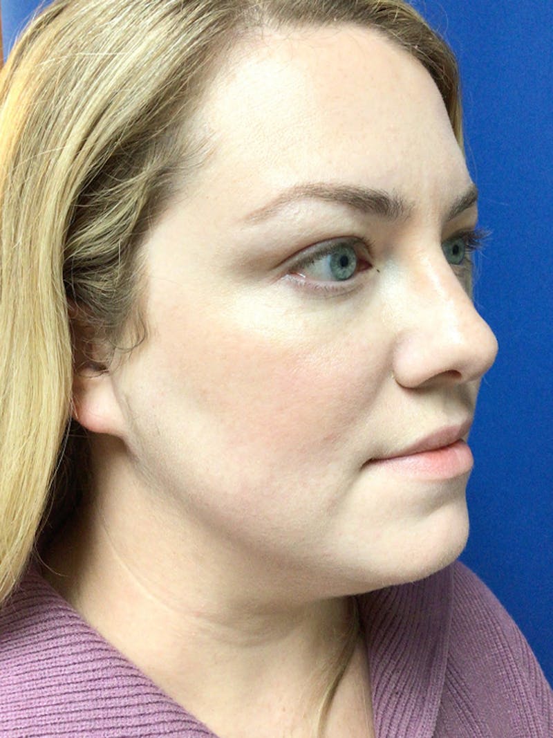 Laser Resurfacing Before & After Gallery - Patient 376837 - Image 2