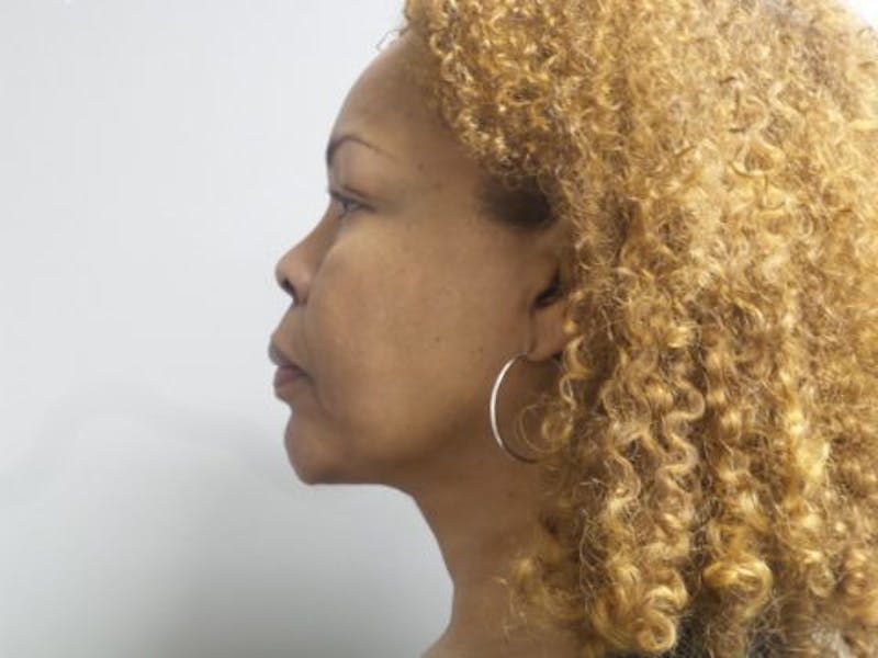 LazerLift Before & After Gallery - Patient 323667 - Image 2