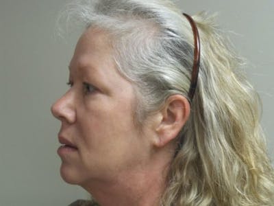 LazerLift Before & After Gallery - Patient 251607 - Image 1