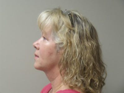 LazerLift Before & After Gallery - Patient 251607 - Image 2