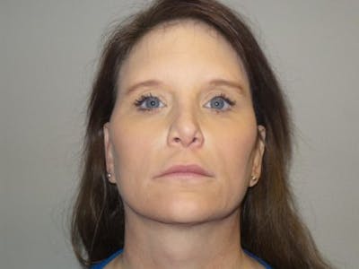 LazerLift Before & After Gallery - Patient 232337 - Image 1