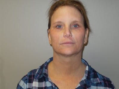 LazerLift Before & After Gallery - Patient 232337 - Image 2