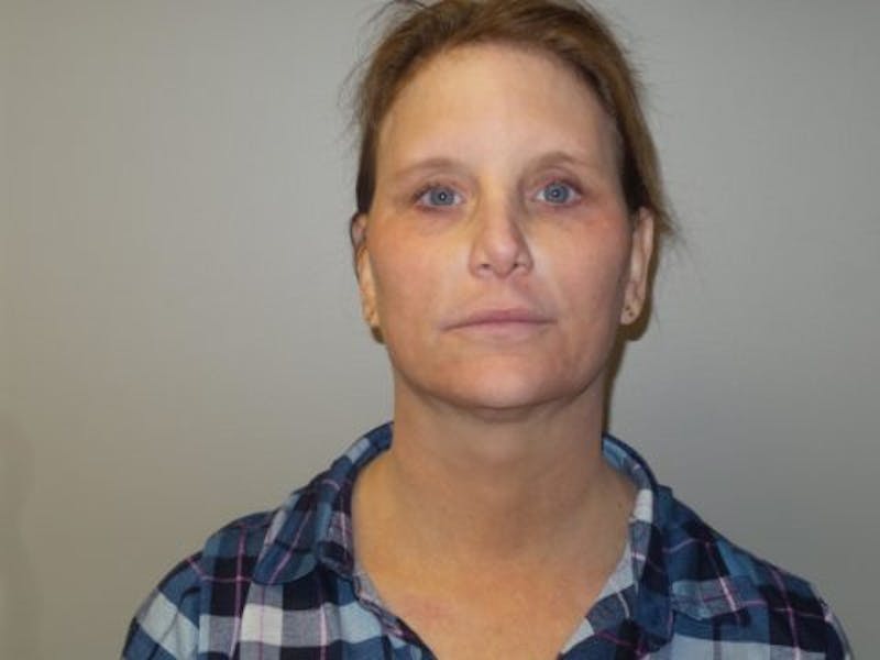LazerLift Before & After Gallery - Patient 232337 - Image 2