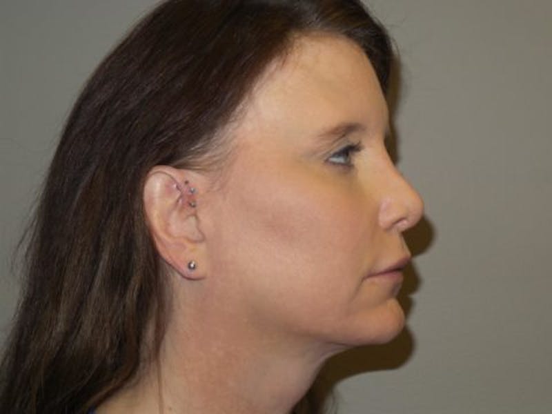 LazerLift Before & After Gallery - Patient 232337 - Image 3