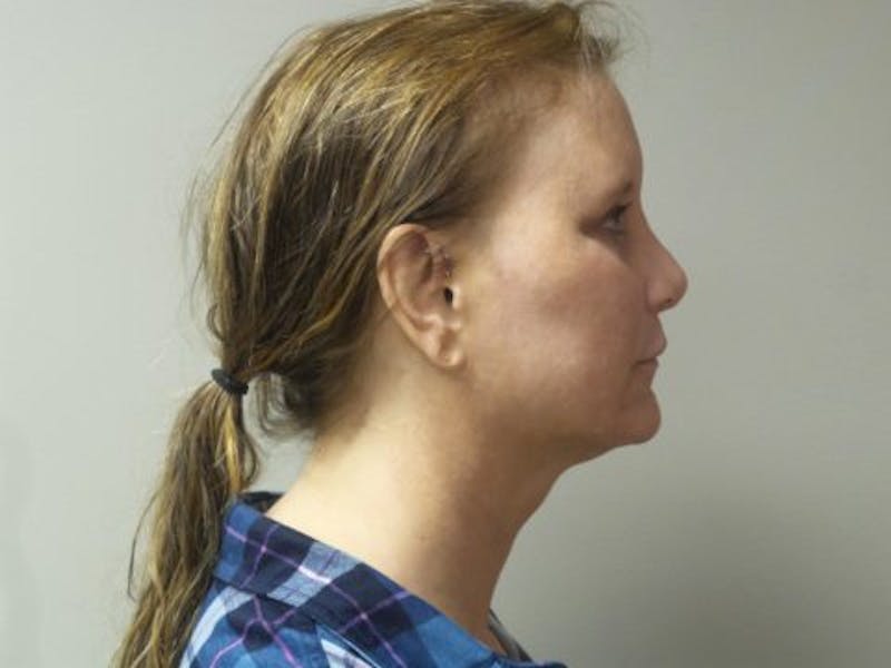 LazerLift Before & After Gallery - Patient 232337 - Image 4