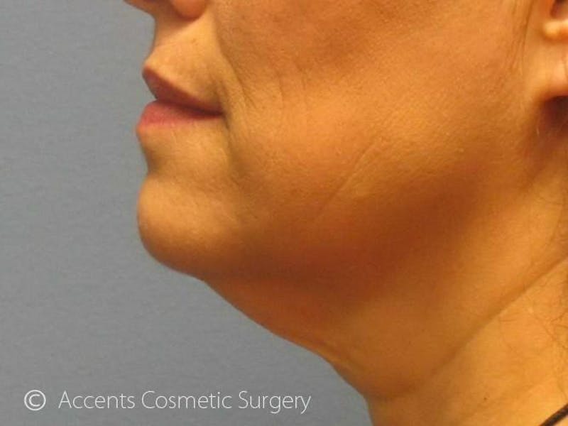 LazerLift Before & After Gallery - Patient 198380 - Image 1