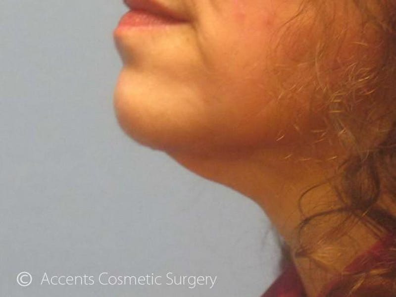 LazerLift Before & After Gallery - Patient 198380 - Image 2