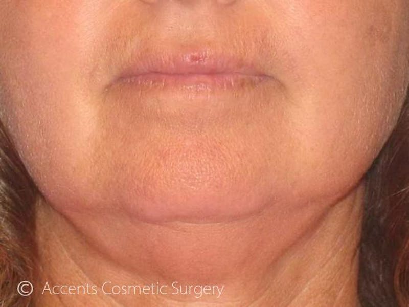 LazerLift Before & After Gallery - Patient 103488 - Image 1