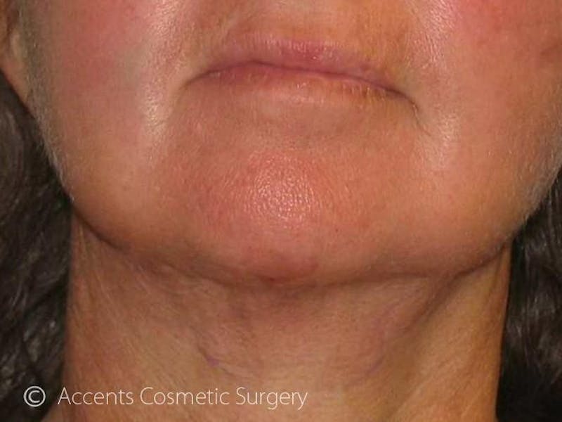 LazerLift Before & After Gallery - Patient 103488 - Image 2