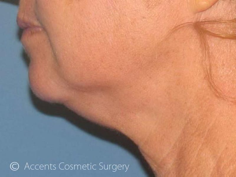 LazerLift Before & After Gallery - Patient 103488 - Image 3