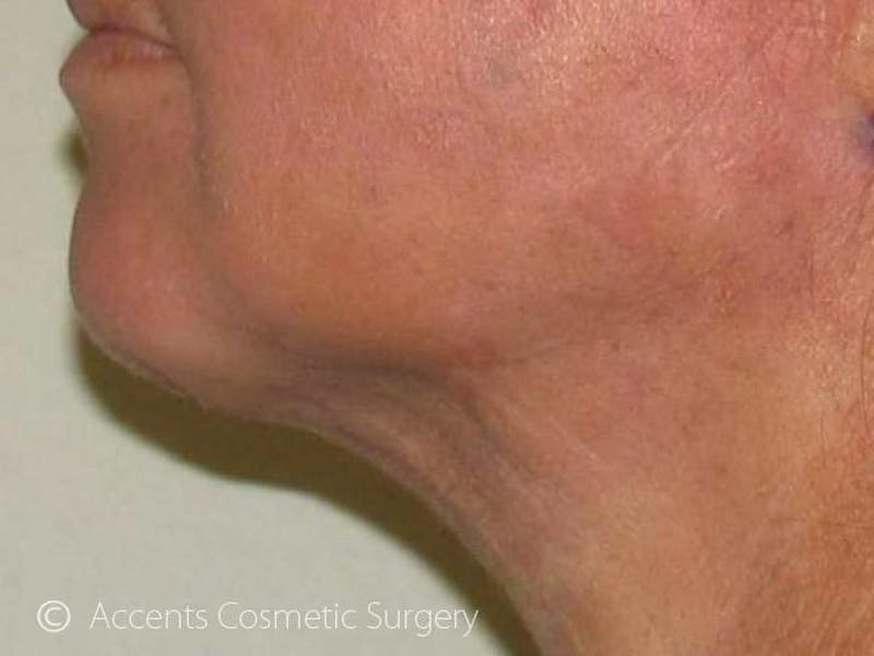 LazerLift Before & After Gallery - Patient 103488 - Image 4