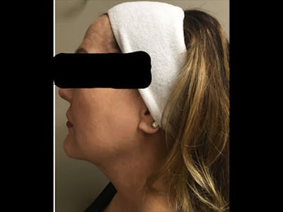 LazerLift Before & After Gallery - Patient 339634 - Image 1