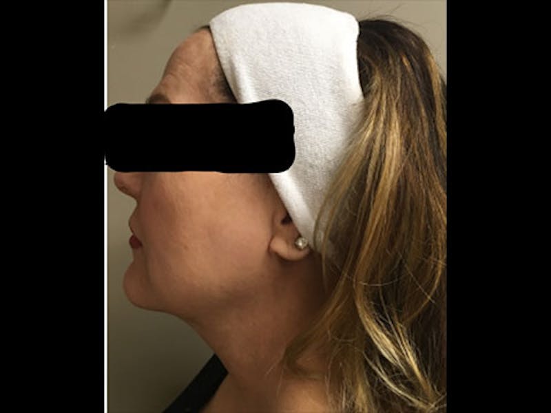 LazerLift Before & After Gallery - Patient 339634 - Image 1