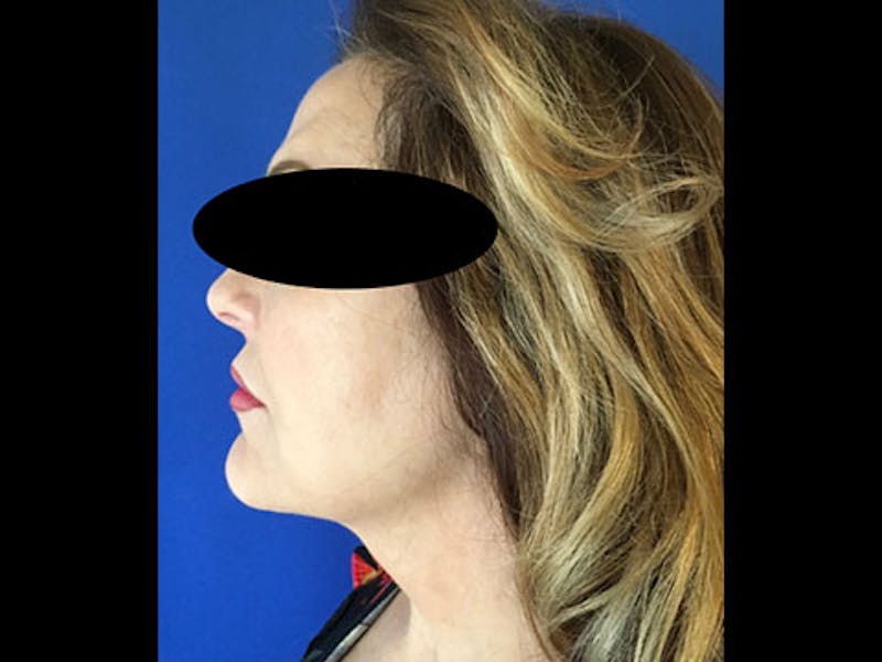LazerLift Before & After Gallery - Patient 339634 - Image 2