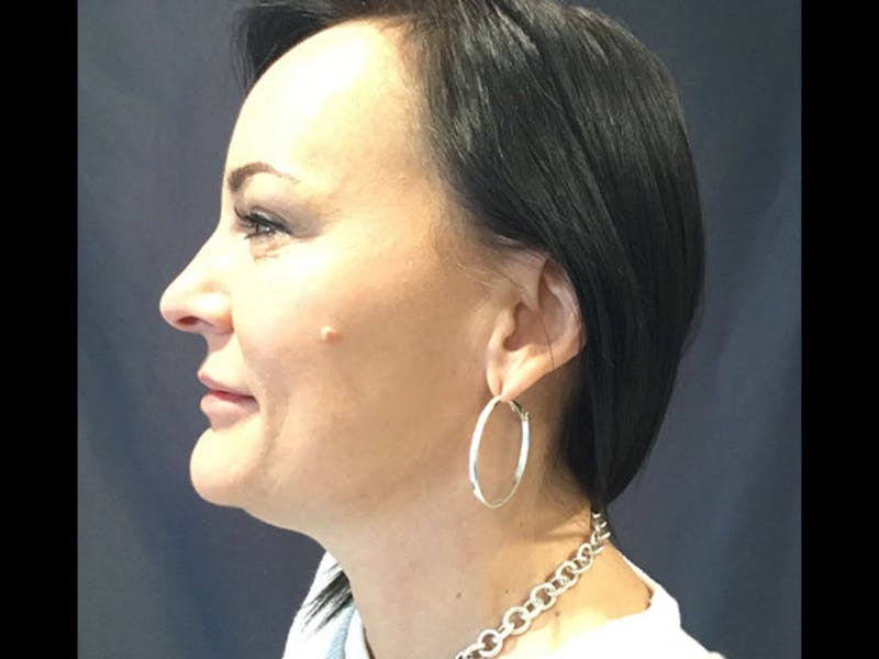 LazerLift Before & After Gallery - Patient 348115 - Image 1