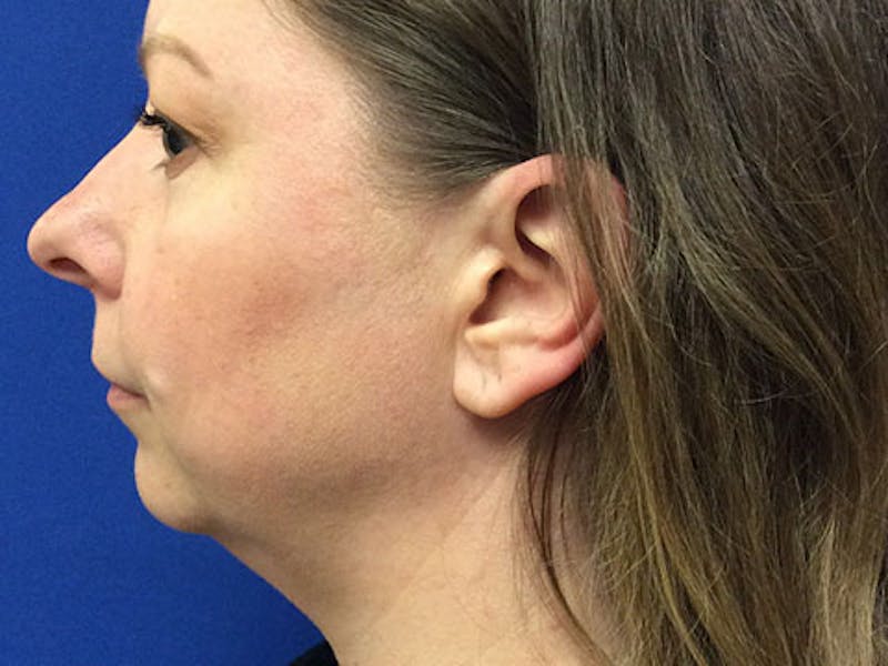 LazerLift Before & After Gallery - Patient 237104 - Image 1