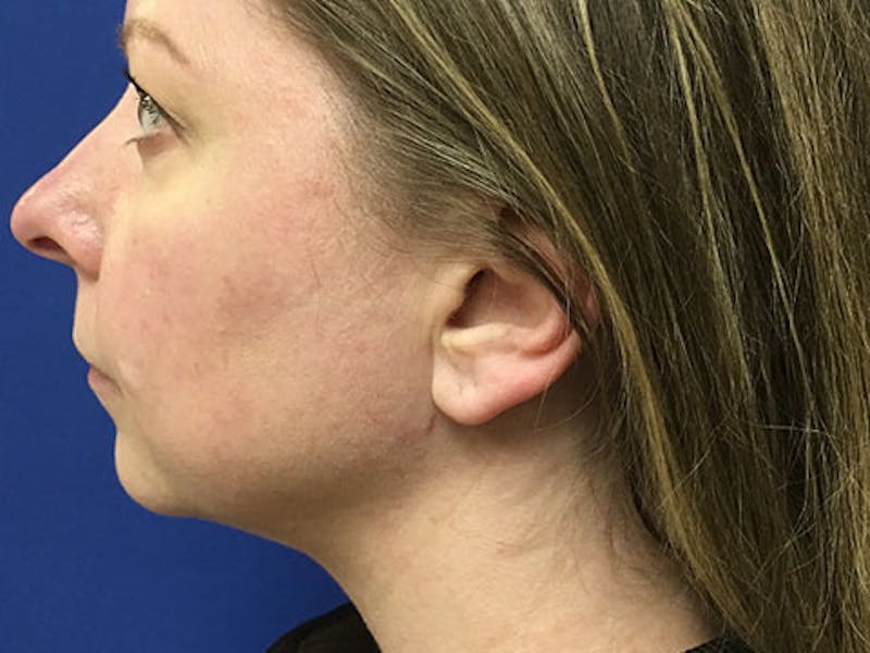 LazerLift Before & After Gallery - Patient 237104 - Image 2