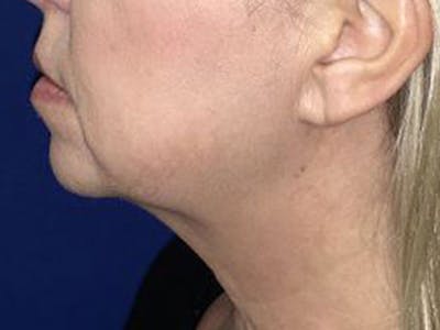 LazerLift Before & After Gallery - Patient 135007 - Image 1