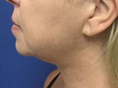 LazerLift Before & After Gallery - Patient 135007 - Image 2