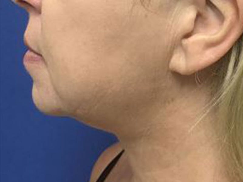 LazerLift Before & After Gallery - Patient 135007 - Image 2