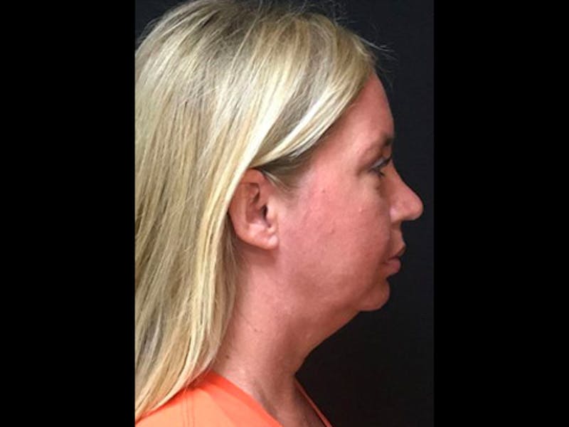 LazerLift Before & After Gallery - Patient 353627 - Image 1