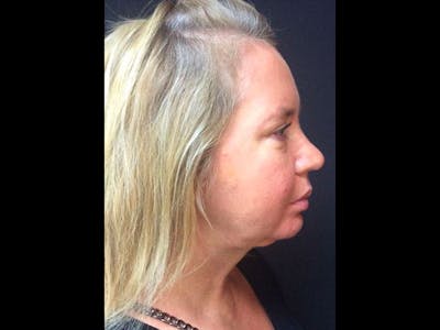 LazerLift Before & After Gallery - Patient 353627 - Image 2