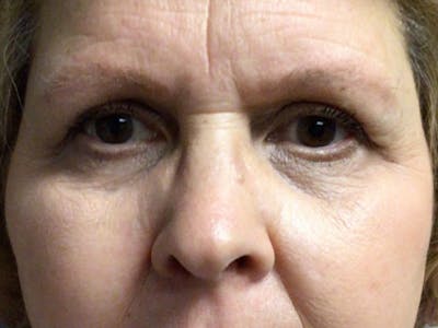 Brow Lift Before & After Gallery - Patient 451854 - Image 1