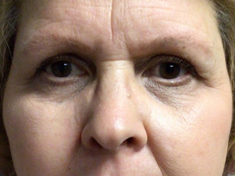 Brow Lift Before & After Gallery - Patient 451854 - Image 1