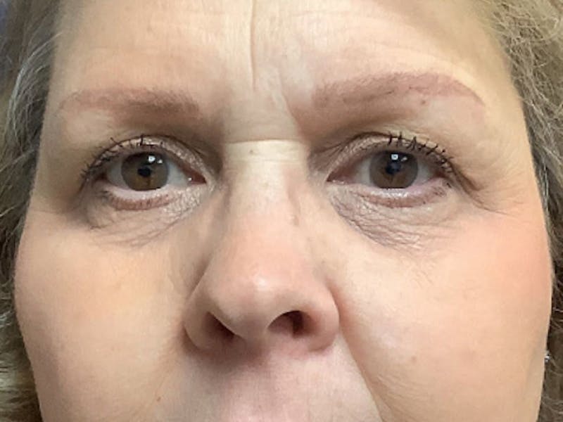 Brow Lift Before & After Gallery - Patient 451854 - Image 2
