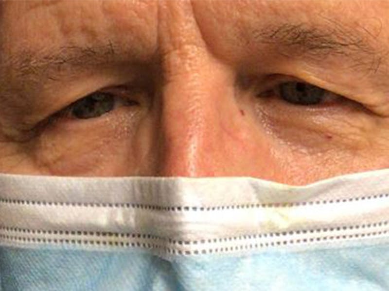 Brow Lift Before & After Gallery - Patient 129923 - Image 1