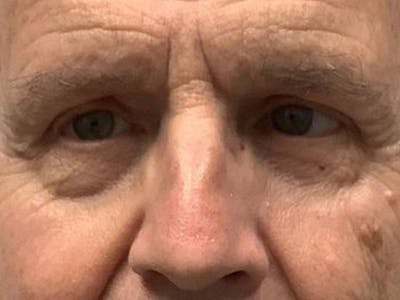Brow Lift Before & After Gallery - Patient 129923 - Image 2