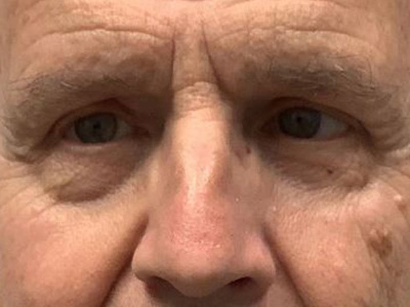 Brow Lift Before & After Gallery - Patient 129923 - Image 2