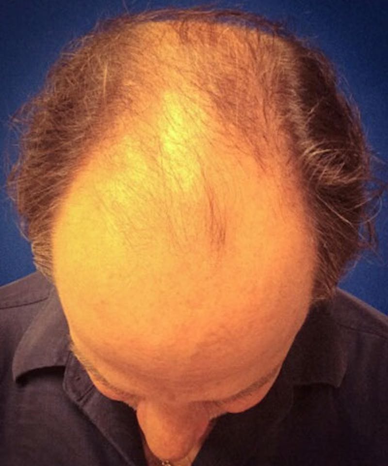 ALMI Before & After Gallery - Patient 826410 - Image 1
