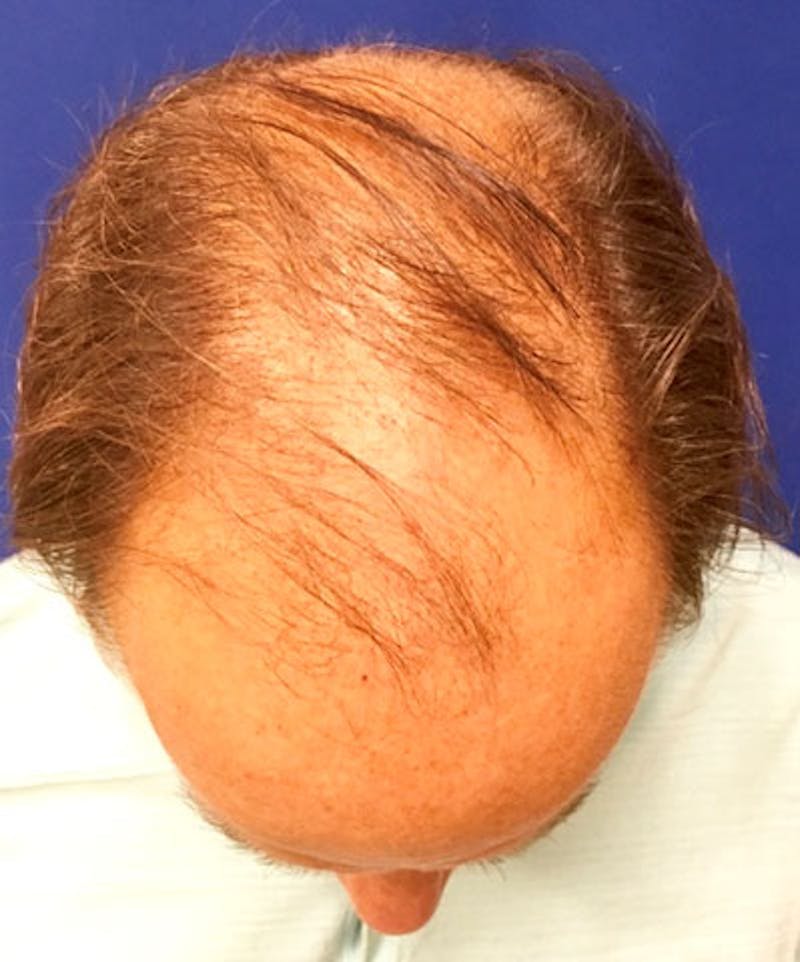 ALMI Before & After Gallery - Patient 826410 - Image 2