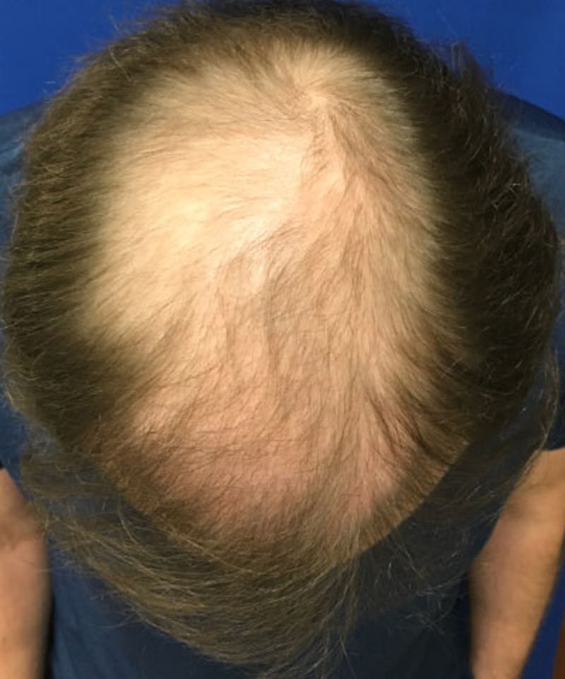 ALMI Before & After Gallery - Patient 131460 - Image 1
